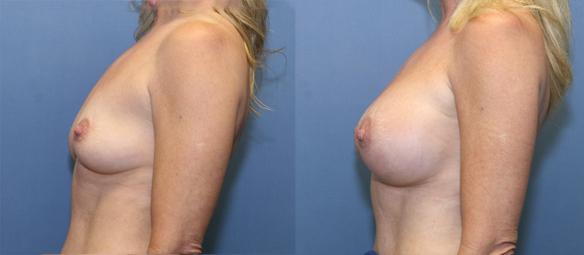D cup size   breast augmentation Beverly HIlls